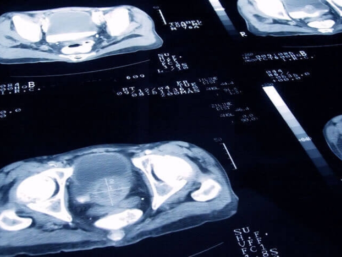 5 things to know about prostate enlargement and treatment options