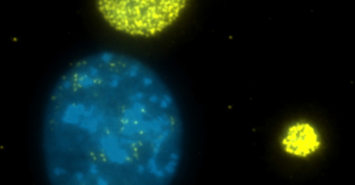 High levels of ammonia in colon tumors inhibits T cell growth and